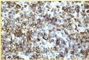 B-cell CLL/SLL B-cell    cutaneous follicular lymphoma Mantle cell lymphoma B-cell Small Lymphocytic Lymphoma (CLL) B-Cell