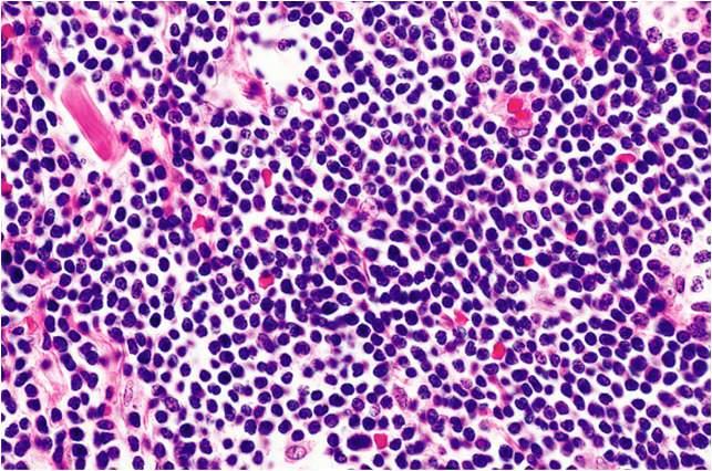 Small Lymphocytic Lymphoma (CLL) Small Mature B-Cell NHL Small lymphocytic lymphoma Tissue variant of CLL Lymphoplasmacytoid lymphoma Older patients, male predominance Paraprotein