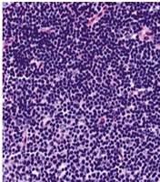 lymphoma (weak) Minority of DLBCL Other B-cell NHLs negative SLL CD5 WHO Classification of B-cell Neoplasms 2008 Differential diagnosis: IHC SLL vs B-LB TdT neg CD5 pos CD23 pos SLL