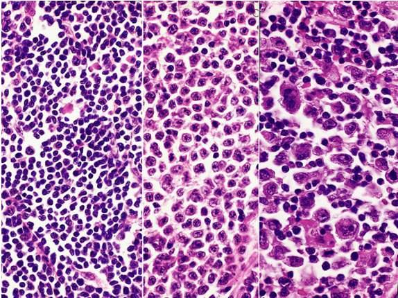 Splenic marginal zone B-cell lymphoma +/- villous lymphocytes/slvl Hairy cell leukemia Lymphoplasmacytic lymphoma Heavy chain disease Plasma cell myeloma Solitary plasmacytoma of