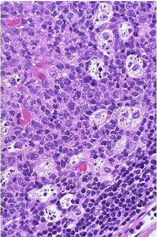 Follicular Hyperplasia Small centrocytes (small cleaved) Large