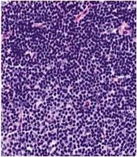 B-CLL B-cells dim reactive T-cells strong* B-CLL / SLL (90%) Mantle cell NHL (90%) 10%+