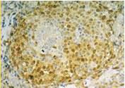 Lymphoma 2 Mantle Cell