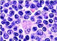 lymphoma Mantle Cell