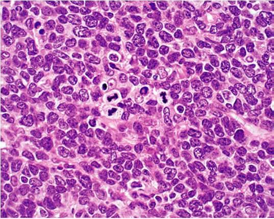 Mantle  Mantle Cell Lymphoma: