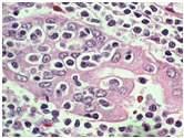 disease Plasma cell myeloma Solitary plasmacytoma of bone Extraosseous plasmacytoma Extranodal marginal zone B-cell lymphoma