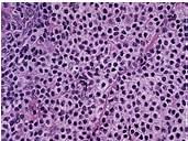(78% GI) Marginal Zone Lymphoma (MALToma) Morphology small centrocyte-like monocytoid B cells plasma cells Immunology