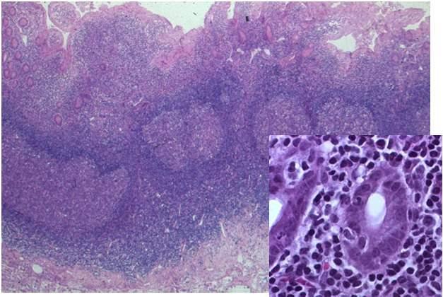 definition Normal MALT: Peyer s Patch extranodal lymphoma heterogeneous small B cells including in varying proportions