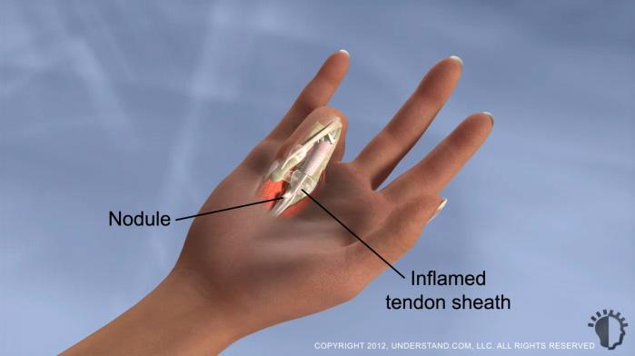 Introduction Trigger finger, also known as stenosing tenosynovitis, occurs when one of the tendons responsible for bending a finger or the thumb develops a thickening, known as a nodule, and