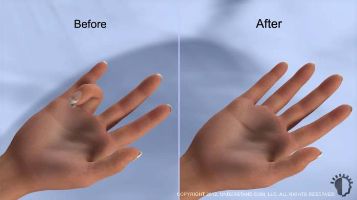 Results and Recovery It may take several hours for the anesthetic to wear off and for feeling to return to your hand.