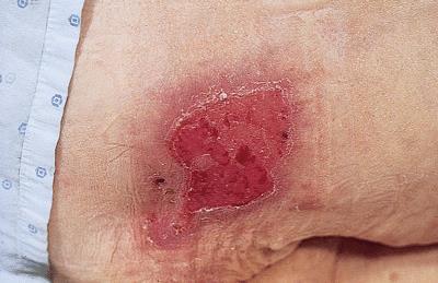 Stage 2 Partial thickness loss involving epidermis and