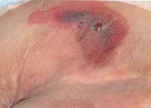Deep Tissue Injury Purple or maroon