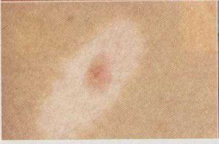 Nevus Rapid growth Resembles melanoma <1cm, red/pink or brown/black