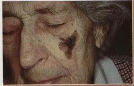 Malignant Melanoma Lentigo maligna Elderly faces Very slow growing Can reach large