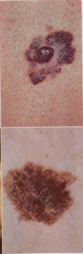 Malignant Melanoma Cummings plate 2 Superficial spreading 75% overall Rarely greater than 2cm prior to dermal invasion