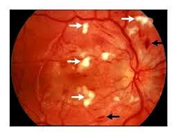 It can be appear as yellow-white patch on the retina (see in Figure 2.). They are caused by damage to nerve fibers and when there is swelling in the surface layer of retina. 1.
