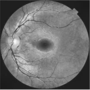 Grade 0 is that stage when there is in no microaneurysms are detected so we can conclude that the person does not have diabetic retinopathy.
