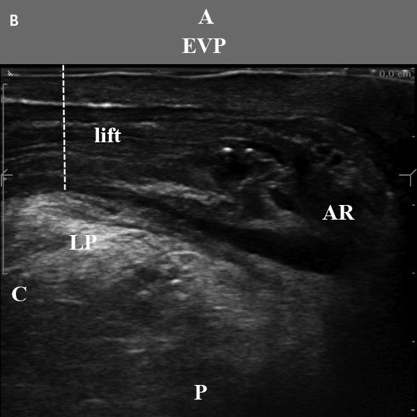 Distance between the levator plate and endovaginal probe on dynamic endovaginal sonography at rest (A) and during a Kegel contractions (B).