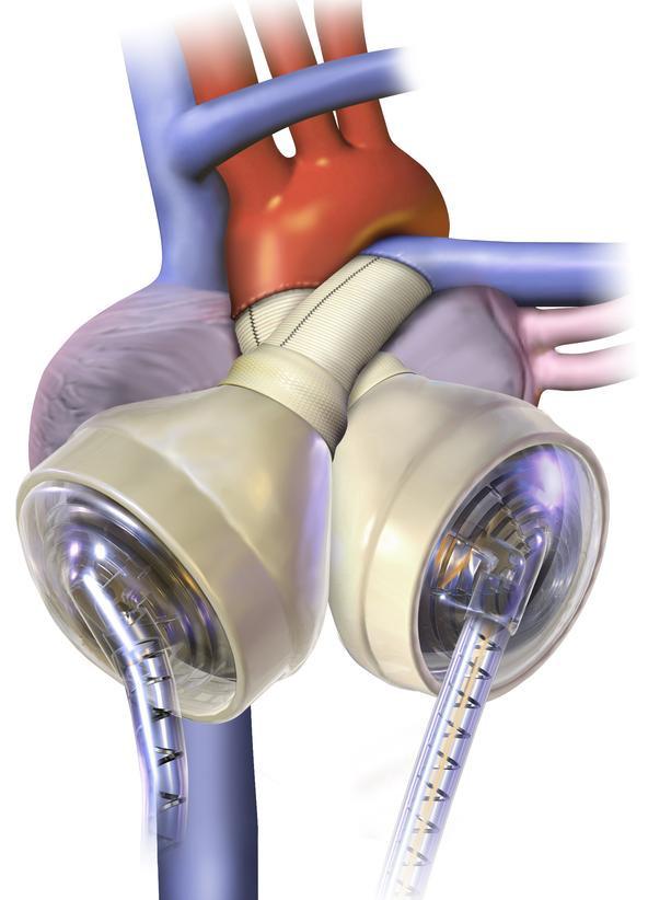 The patient s care team considers the first total artificial heart procedure to be a complete success, as both the short-term and long-term goals were accomplished.