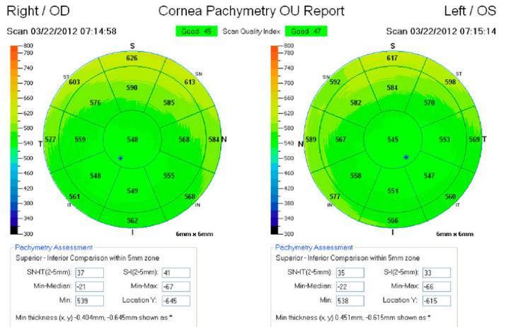 Corneal pachymetry via OCT: various ocular diseases in her office without referring the patients out for specialty care.