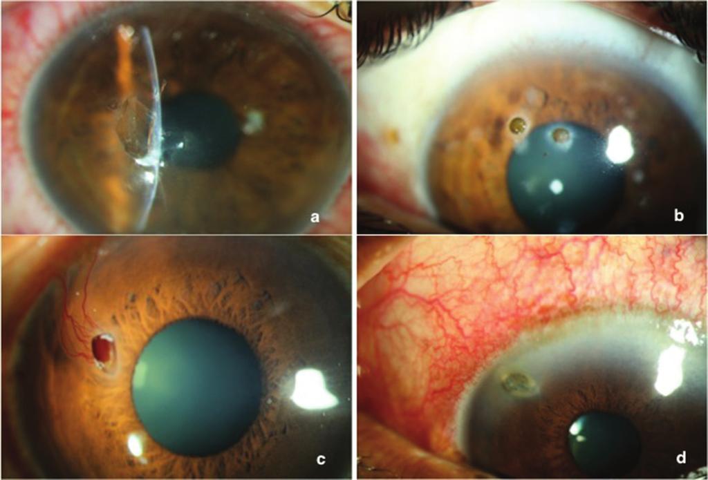 The cornea is prone to injury by foreign bodies; approximately 4-7% of ocular injuries in