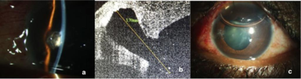Figure 3: Patient presenting with intracorneal glass foreign body (a): Slit lamp photograph showing glass within deep stroma (b): ASOCT shows breach in endothelium with glass extending into the