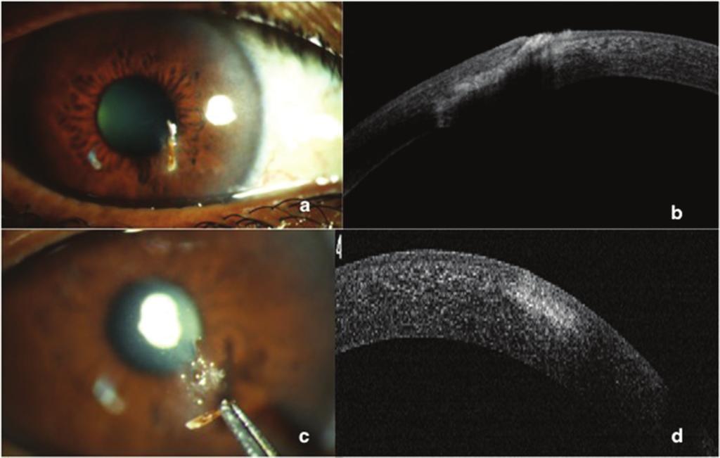 Ocular Trauma Figure 4: Patient presented with intracorneal wood foreign body.