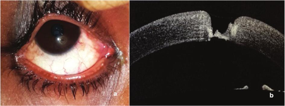 Diagnostics: Role of ASOCT in Intracorneal Foreign Body Figure 5: Patient presented with pain after removal of intracorneal foreign body (a): Slit lamp photograph at presentation showing inferior
