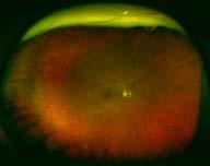 injections / year OS: Ranibizumab x 2; focal laser; bevacizumab x 2 Reluctant to treat further given poor vision