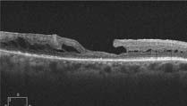 found Fovea: Not found Fovea: Not found Past ocular history NPDR with