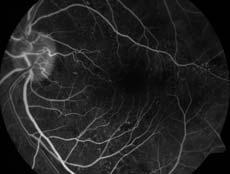 Pre-Navilas treatment Options: FA shows mild ischemic changes within the fovea no evidence of neovascularization elsewhere VA OS 20/40 1. Anti-VEGF 2.