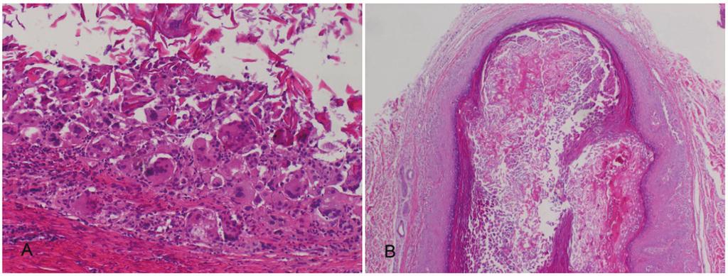 Figure 2. A. Giant cells in the cyst (H&E, 100). B. A pilomatricoma-like changes (H&E, 40). Table 1.