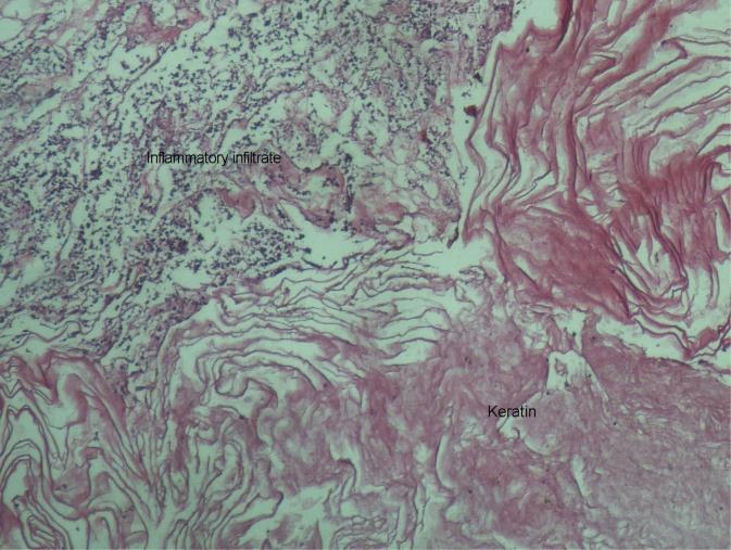 and an area of chronic inflammatory infiltrate Figure 3: H&E stained