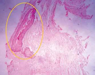 Daughter-cyst-like areas under 10 pathogenesis of these cysts is unknown;however, it is assumed that they develop due to the