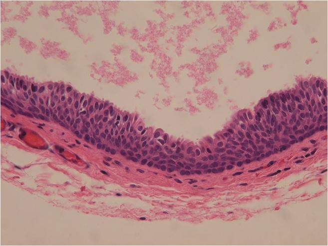 Apart from the absence of umbrella cells, the histological features of the epithelium were similar to those of the urothelium. A pure squamous epithelium lining was found in 3 cases (5.