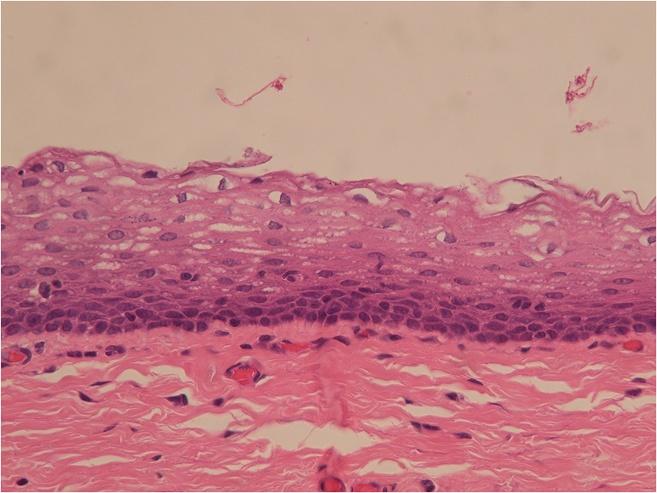 7%) were of the mixed type, that is, the epithelial lining either coexisted with squamous metaplasia or was scattered with mucinous cells. Two cases had focal ciliated cell metaplasia (Figure 6).