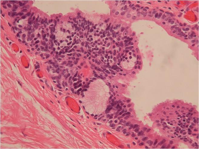 Among the 55 patients, 1 underwent cyst aspiration, and recurrence was noted several months later. No signs of malignancy were found in any of the patients, either clinically or pathologically.