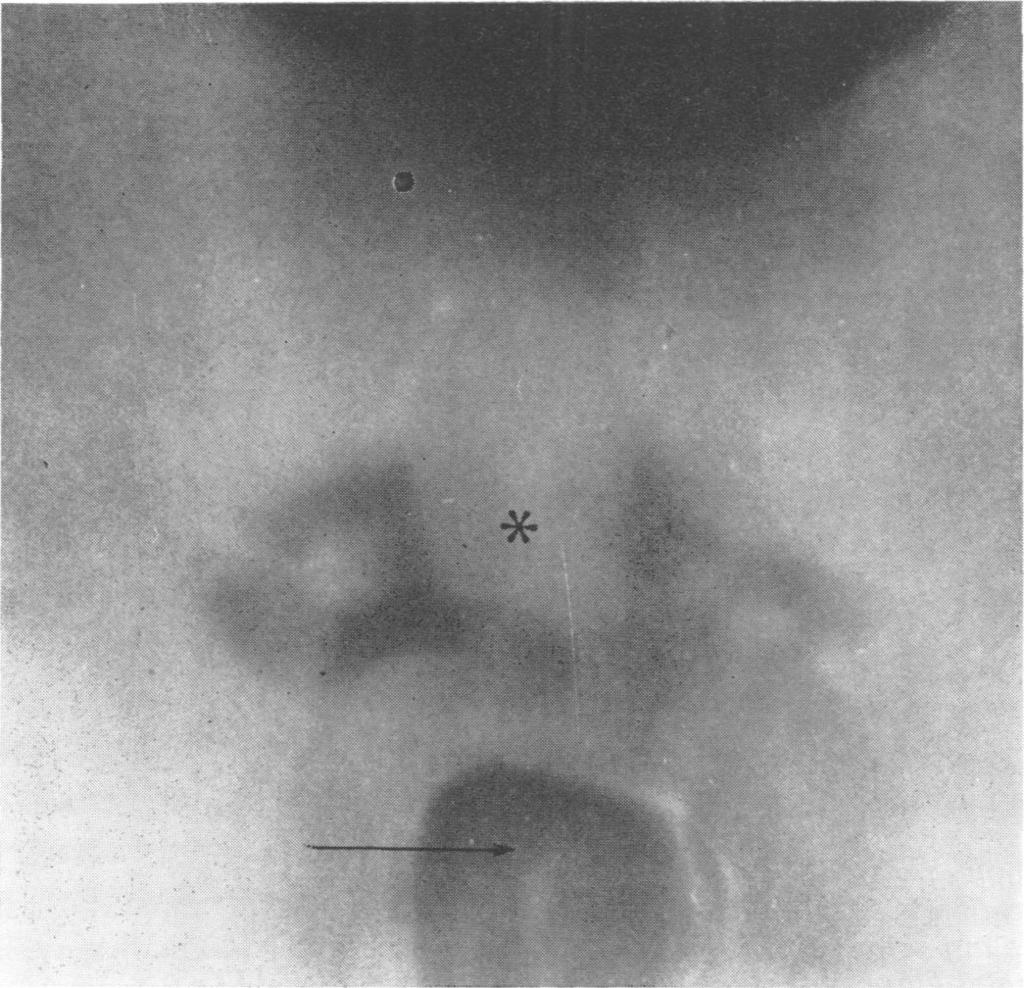 Blue-domed cyst with optic nerve compression.i-. FALX i;./ ~~~~~~~~~~~~~~~~~~.4I I OPTIC N.- INTERNAL CAROTID A. CHIASM _ Fig.