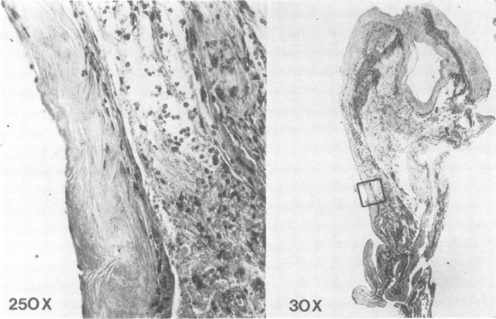 990 Discussion Mitchell D. Burnbaum, John W. Harbison, John B. Selhorst, and Harold F. Young % V. 10.~~~~~1 250X 30X ' Fig. 5 H and E histological section of cyst.