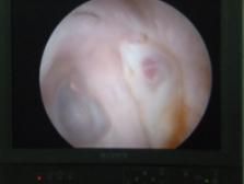 Fig. 1: Endoscopic Picture An intact, dull tympanic membrane and granulations seen in the