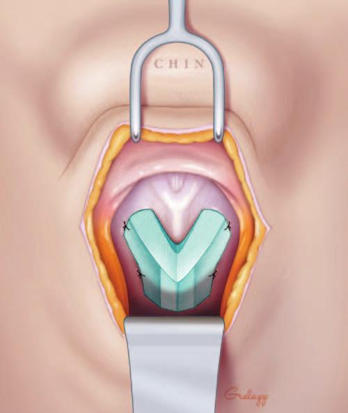 Anatomical illustration of rib graft secured on top of existing thyroid cartilage with two sutures on each side. (Printed with permission from Christine Gralapp Medical Illustration.