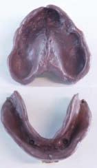 12 First stone models obtained from the extended alginate impressions: All the buccal anatomy necessary for the construction of the prosthesis must be visible. Fig.