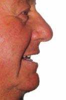 The edges of the trays have an average thickness of 2mm. In the sublingual area and distally to the zygomatic areas, higher thicknesses of the edges (around 3-4 mm) are allowed (Fig. 13).
