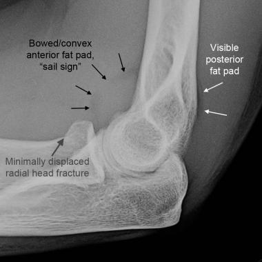 Radial head fracture Mechanism: most common elbow fracture in adults, generally from a fall onto an outstretched hand Exam: