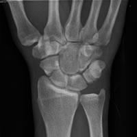 Radial wrist pain after a FOOSH injury should be
