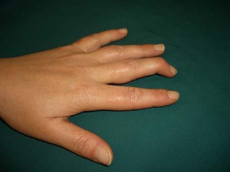 *Mallet Finger* Mechanism: from forced flexion of an extended DIP joint with rupture of