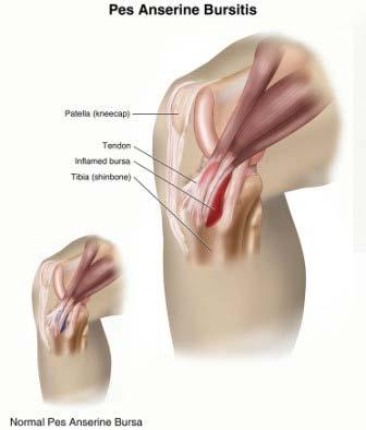 Pes anserine bursitis Mechanism: excessive friction from the pes anserine tendons causes irritation of the bursa.