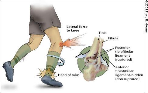 High ankle sprain Mechanism: external rotation of