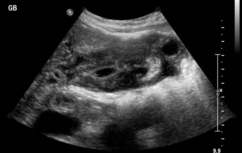 Fig. 6: Gallbladder