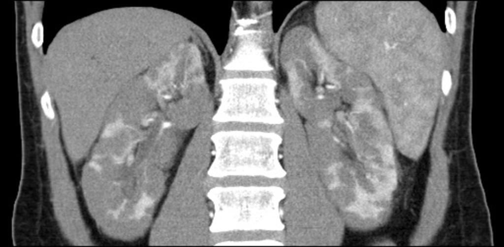 Fig. 9: Multiple hypo-attenuation cortically-based lesions within both kidneys.
